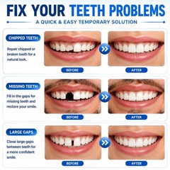 10.9oz Moldable False Teeth Beads Tooth Repair Kit,Repair Thermoplastic Bead…